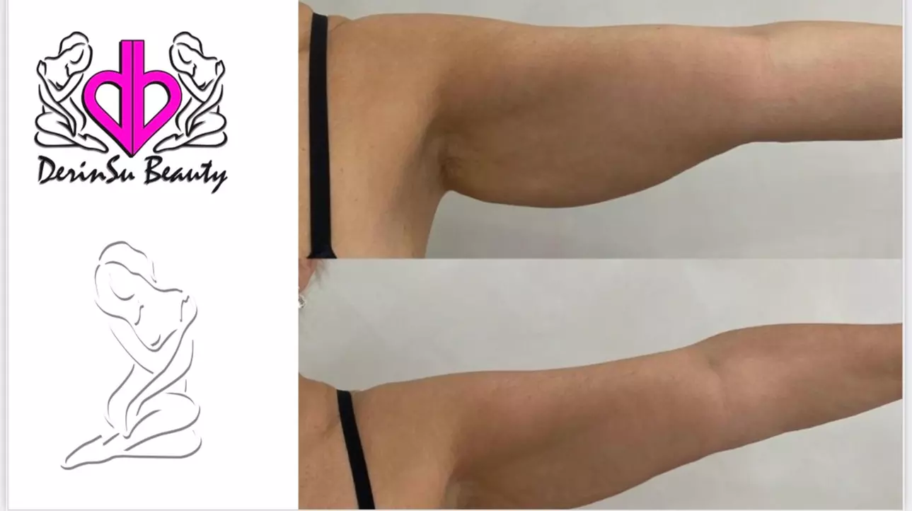 Up to 77% Off on Fat Reduction - Non-Branded at Derinsu Beauty