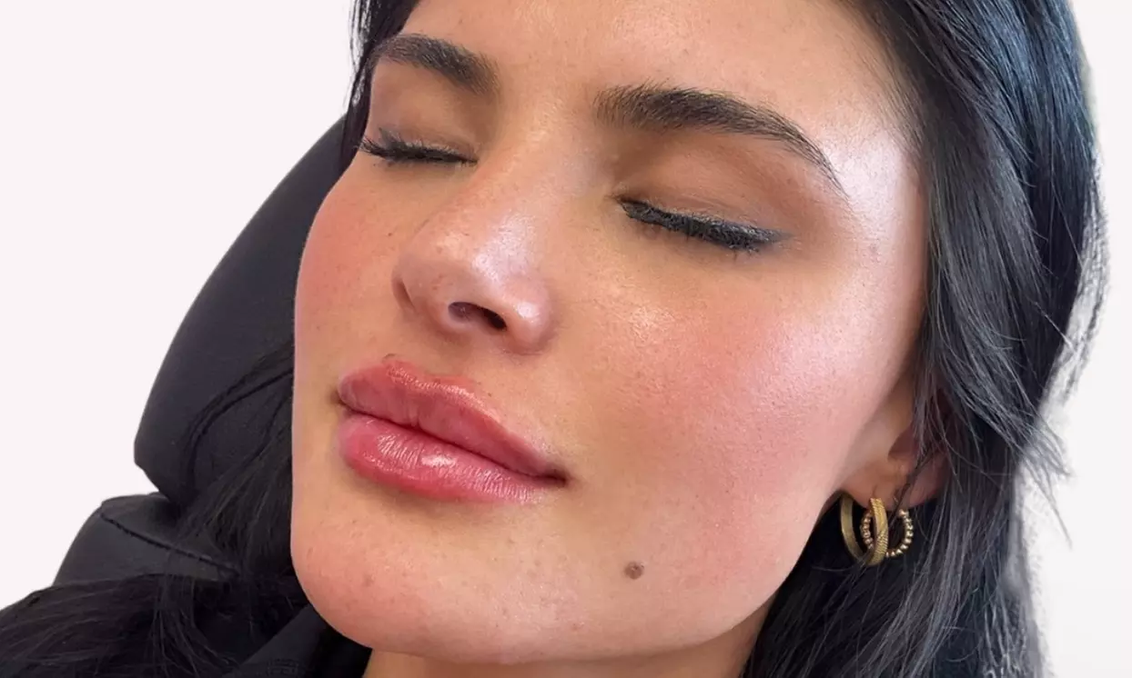 Up to 40% Off on Injection - Dermal Filler at Hush Aesthetics, LLC