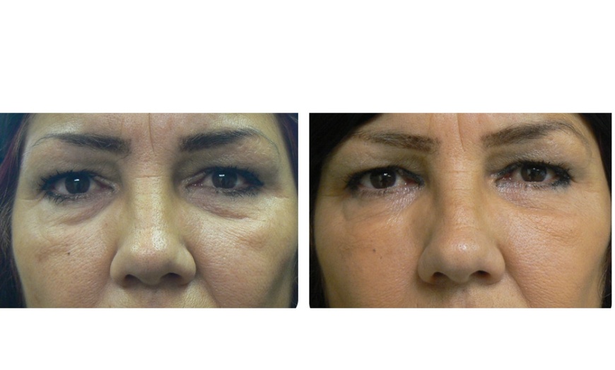 Image 5: One Belotero syringe for undereyes