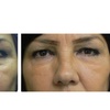 Image 5: One Belotero syringe for undereyes