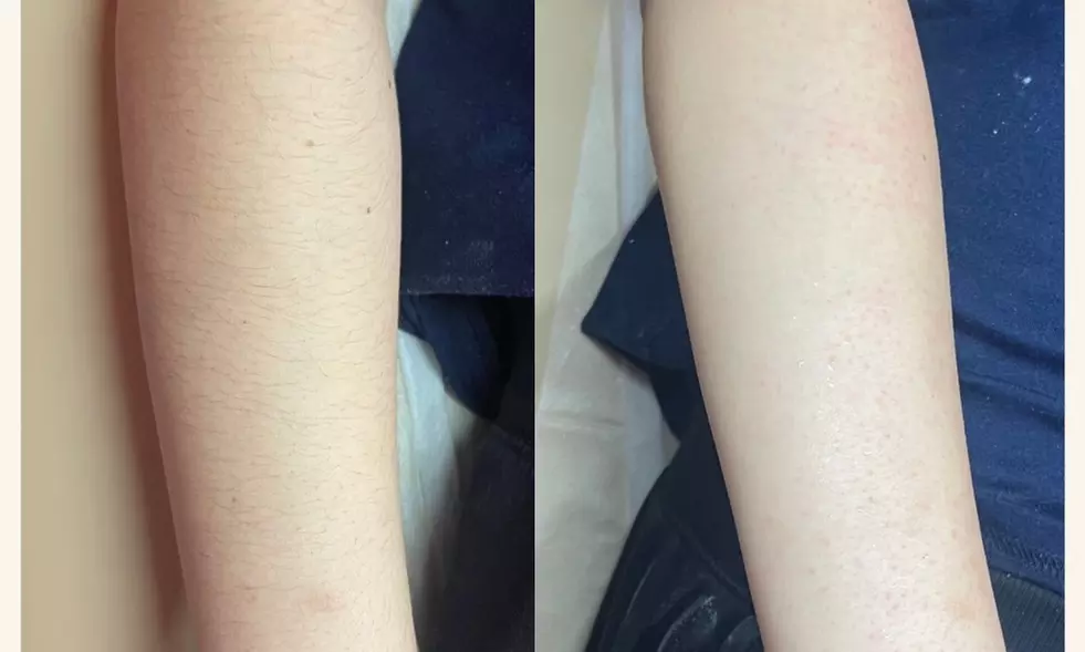 Get smooth skin with The Rose Room's full or half leg sugaring sessions, up to 50% off for a silky finish - Second Medium