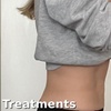 Image 1: Up to 82% Off on Fat Reduction - Non-Branded at L.A. Fat Freeze
