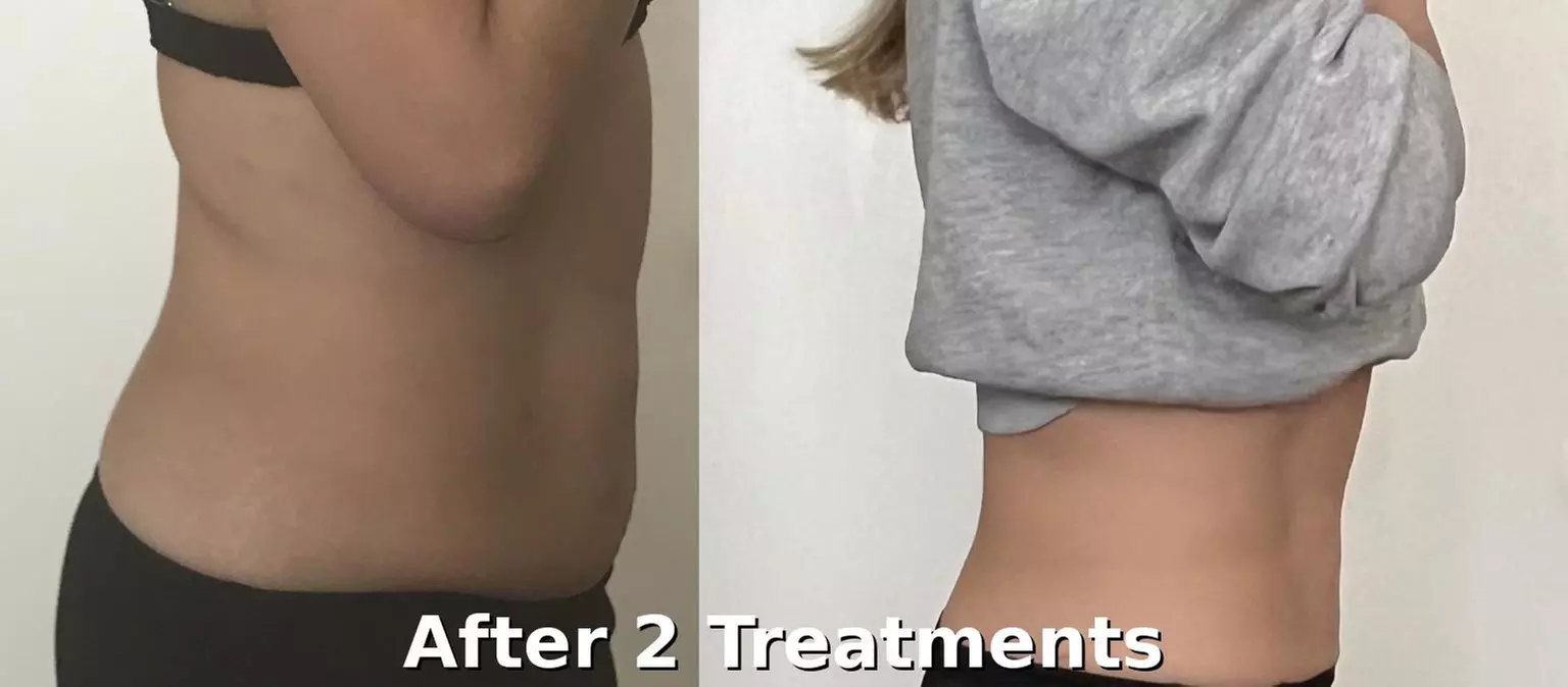 Up to 82% Off on Fat Reduction - Non-Branded at L.A. Fat Freeze