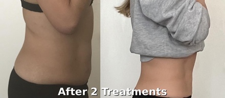 One Fat-Freezing Treatment with Two Applicators - L.A. Fat Freeze