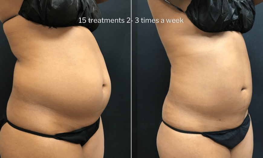 Image 4: Green Laser Lipo Fat Reduction - Up To 4 inches Loss