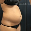 Image 4: Green Laser Lipo Fat Reduction - Up To 4 inches Loss