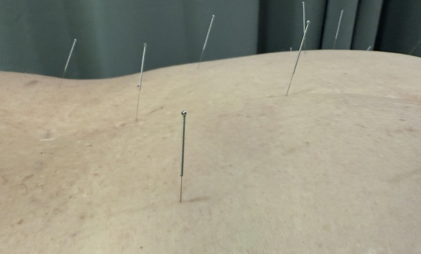 Image 6: Relax w/ an Initial 80-Minute or 70 Minute Follow Up Acupuncture Visit