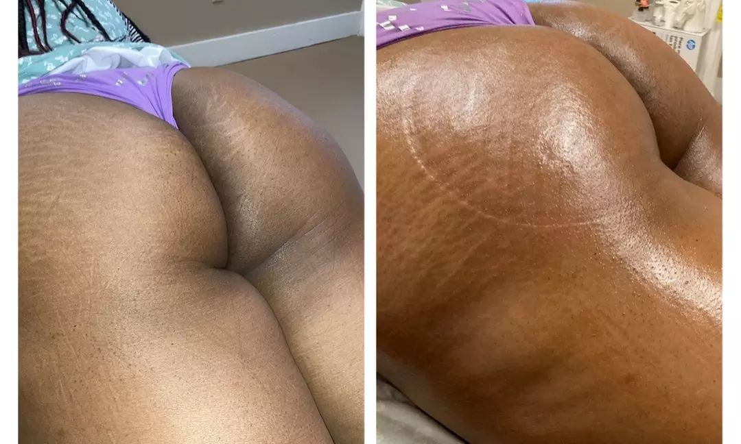 Up to 10% Off on Fat Reduction - Non-Branded at The Unicorn Body Sculpting - Second Medium