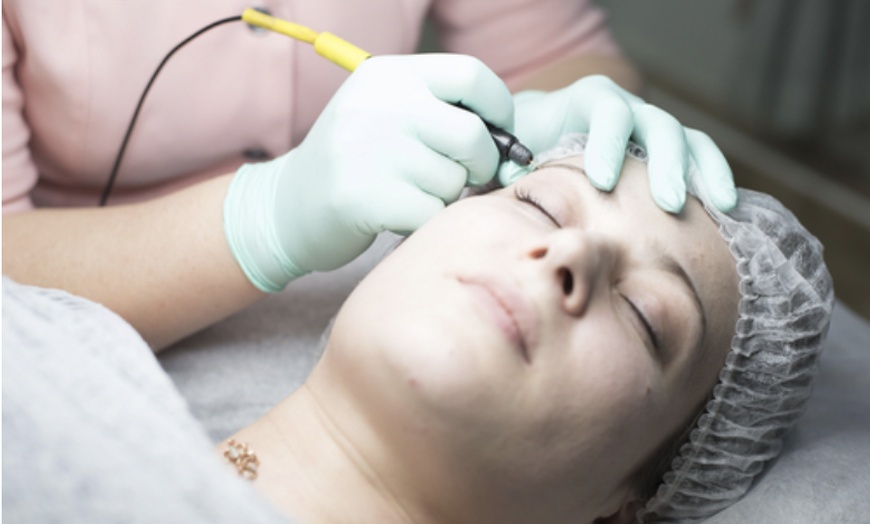 Image 1: Get Smooth Skin with a 30-minute Electrolysis Session