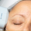 Image 7: Tratamiento HIFU avanzado para tensado facial y corporal no invasivo