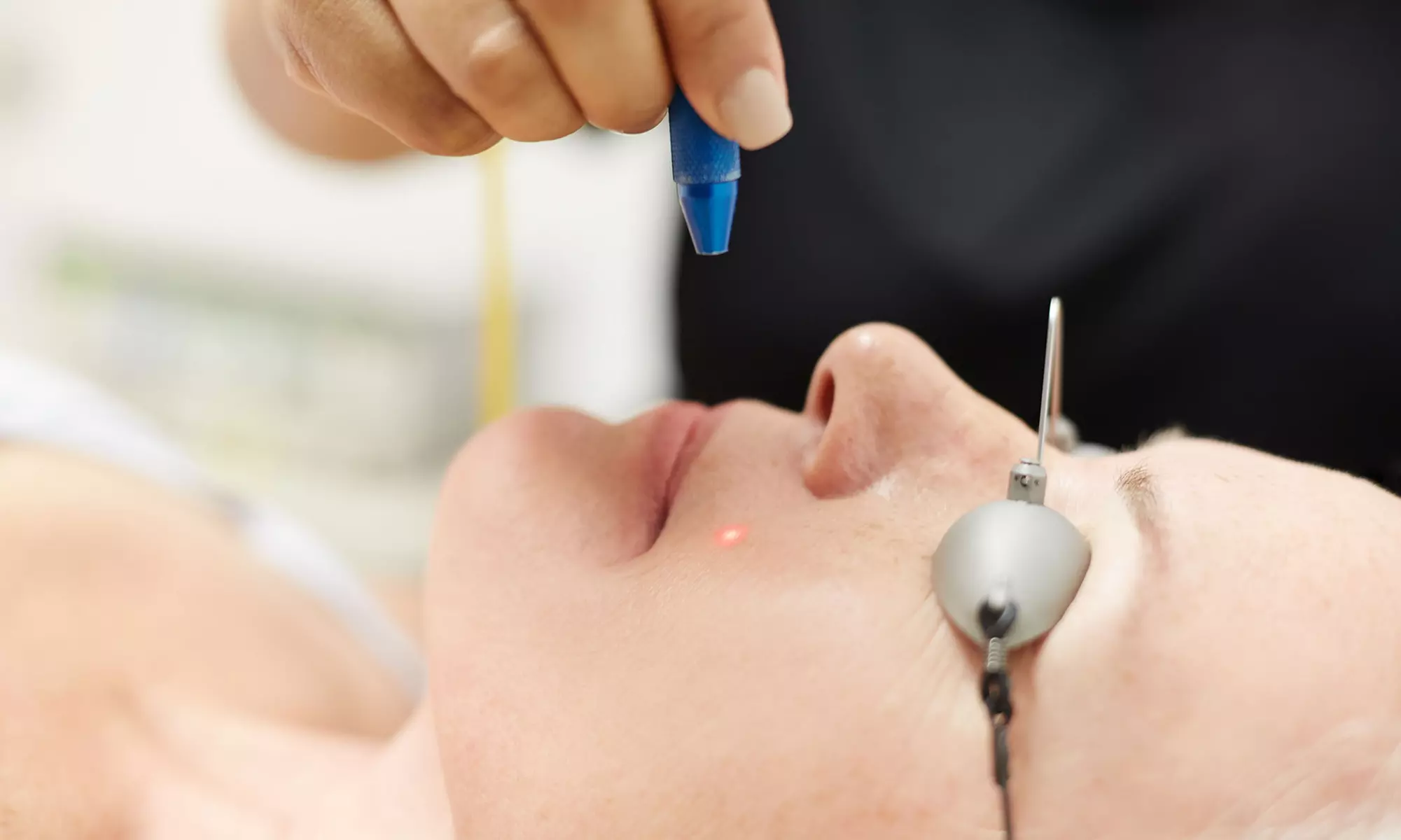 15 or 30-Min Skin Tag, Brown Spot & Spider Vein Removal Up to 6 Spots