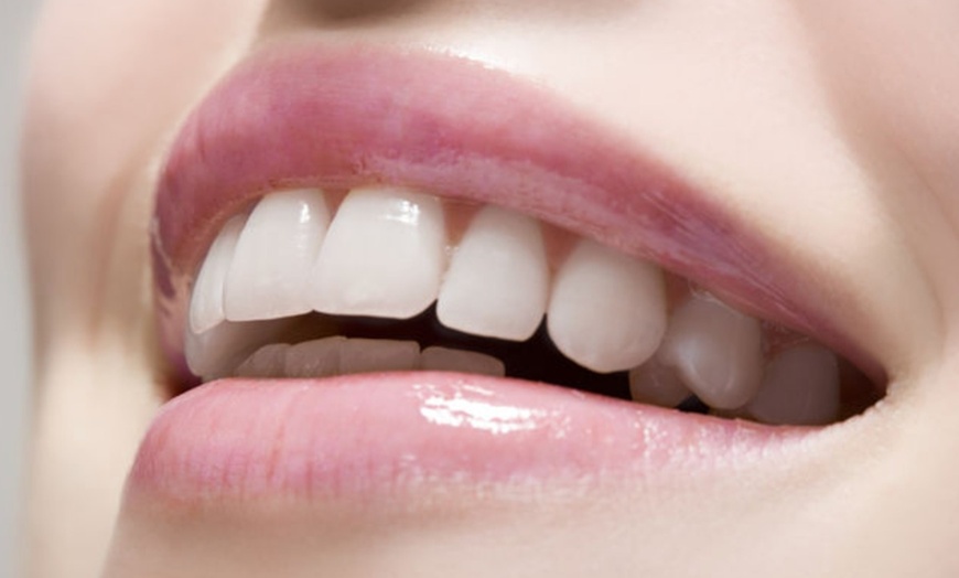 Image 1: Up to 62% Off on Teeth Whitening - In-Office - Non-Branded 