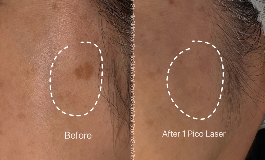 Image 6: Pico Laser Sessions for Small Targeted Areas – 1 or 3 Options 