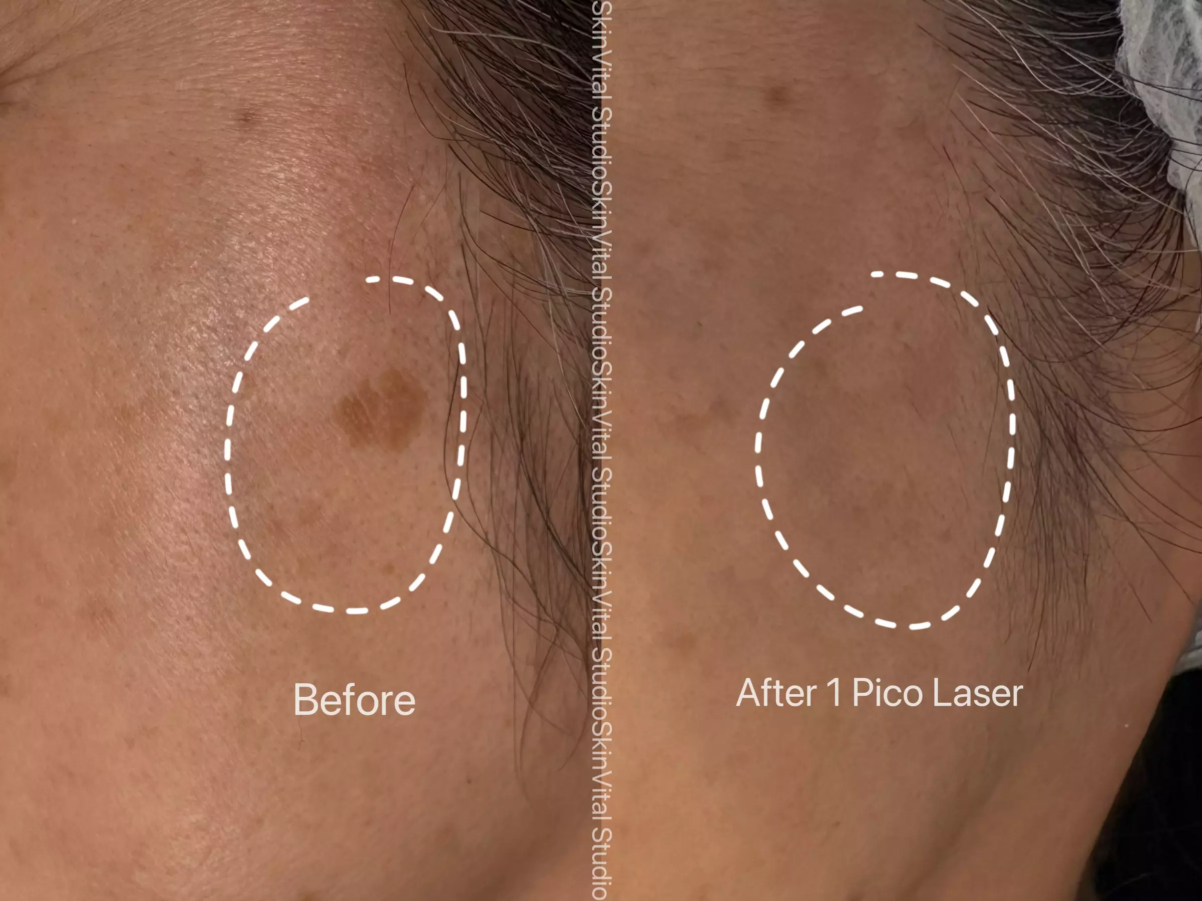 Pico Laser Sessions for Small Targeted Areas – 1 or 3 Options