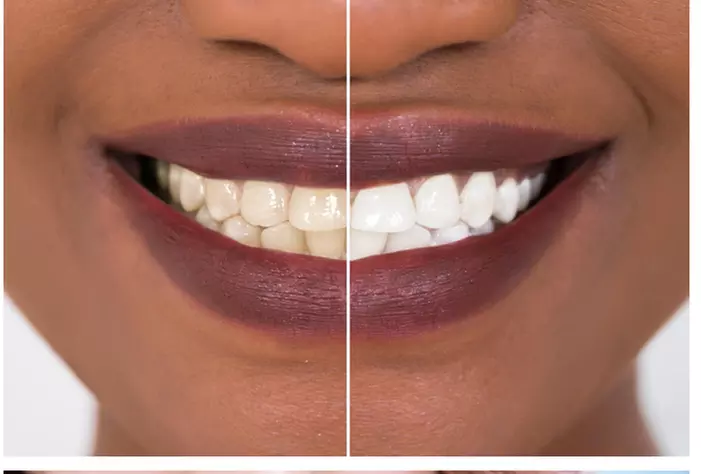 Radiant Smile Awaits with One, Two or Three 1-hour Teeth Whitening Treatments at LV Laser Lounge. Save Up to 62% - Primary Image