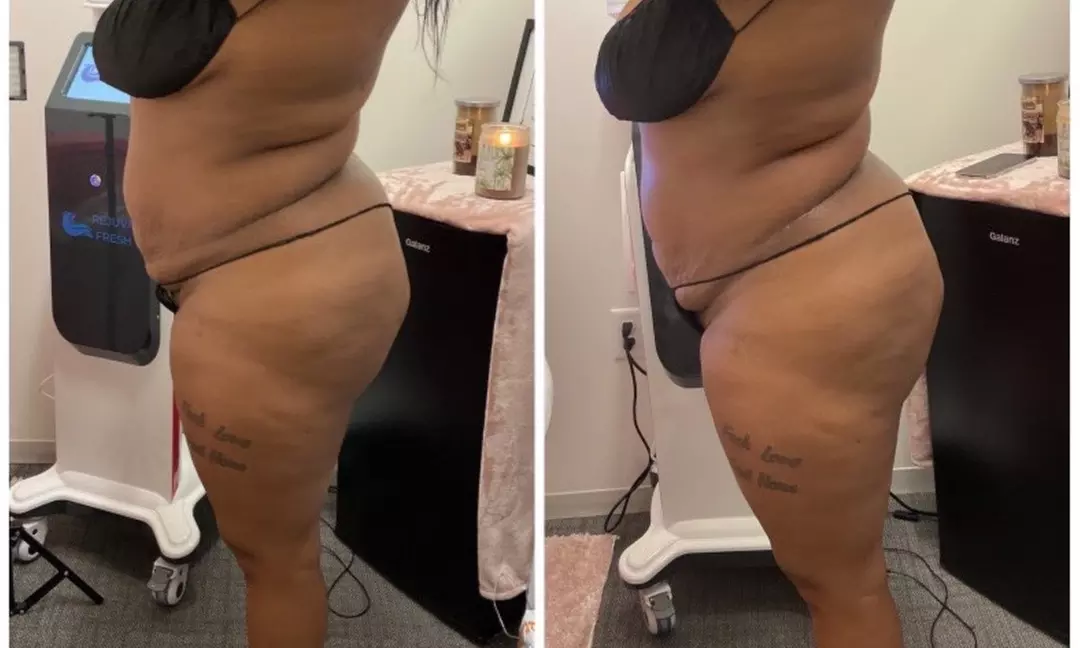 Up to 60% Off on Cavitation at Dyamond sculpted