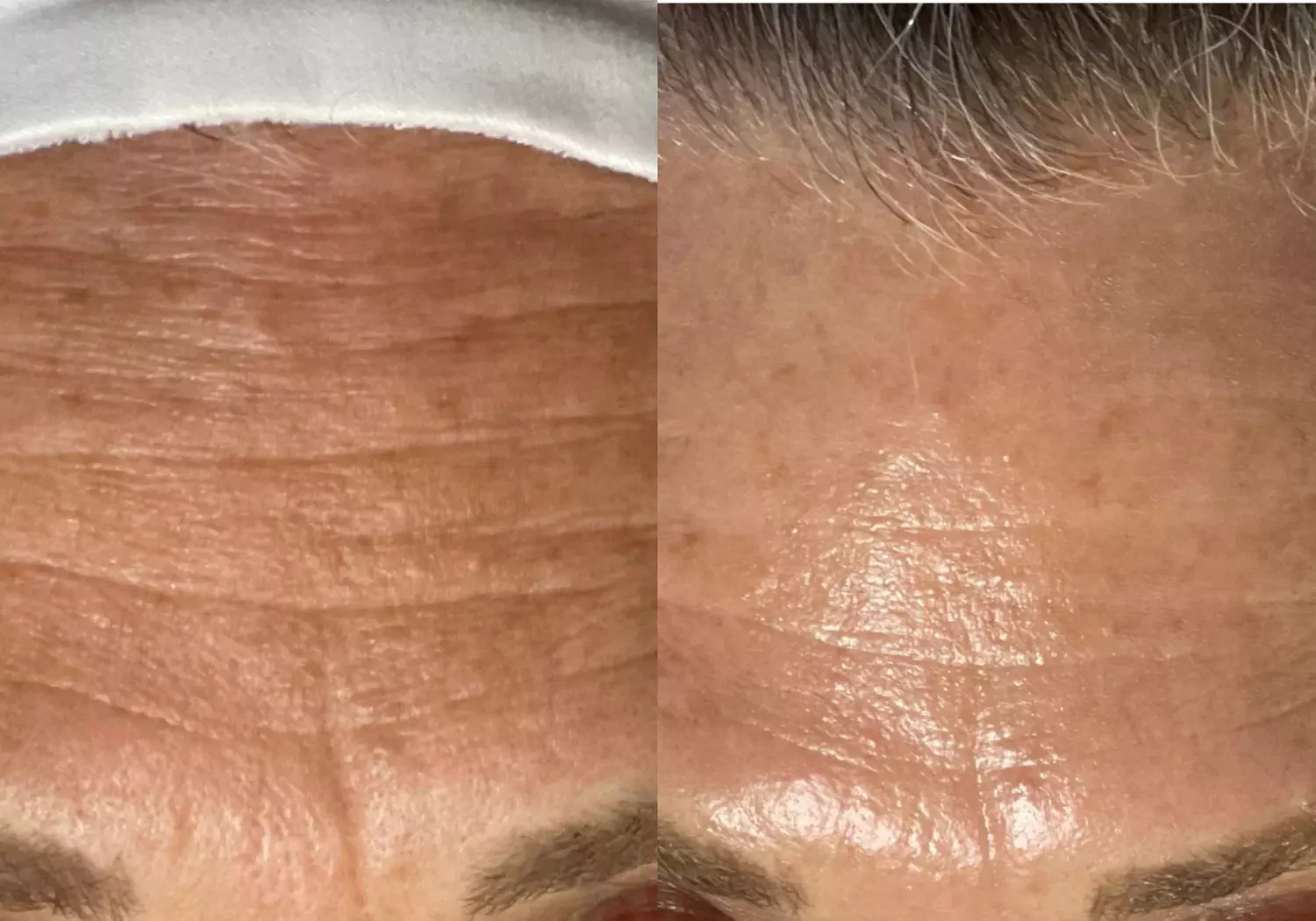 HydraFacial Deluxe with Power Booster and LED Red Light at FlashLaser