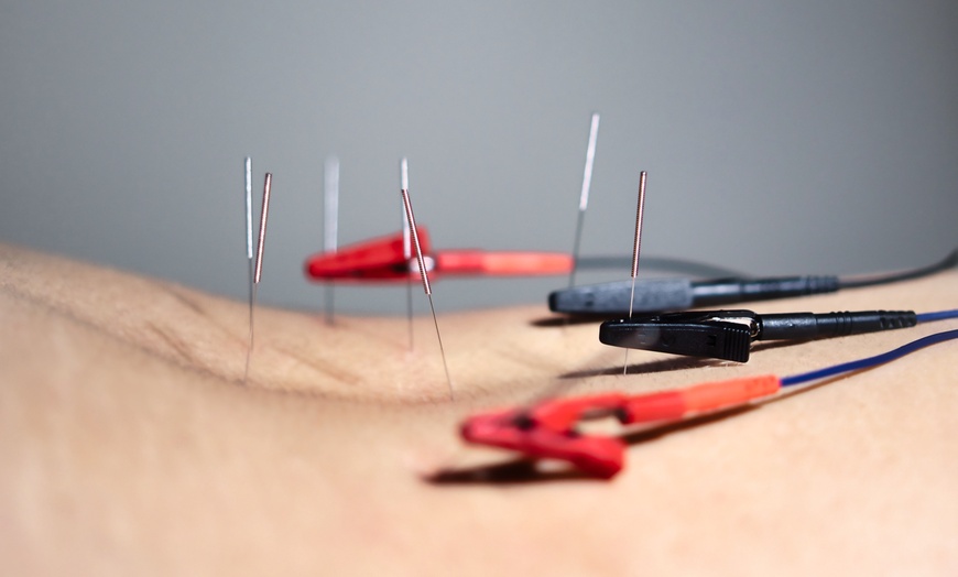 Image 6: 90-Minute Initial Acupuncture or Acupuncture & Cupping Session