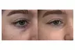 Up to 55% Off on Non Surgical Plasma Fibroblast SkinTightening Upper and Lower Eyelid Lift - Second Medium