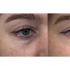 Image 3: Up to 55% Off on Non Surgical Plasma Fibroblast SkinTightening