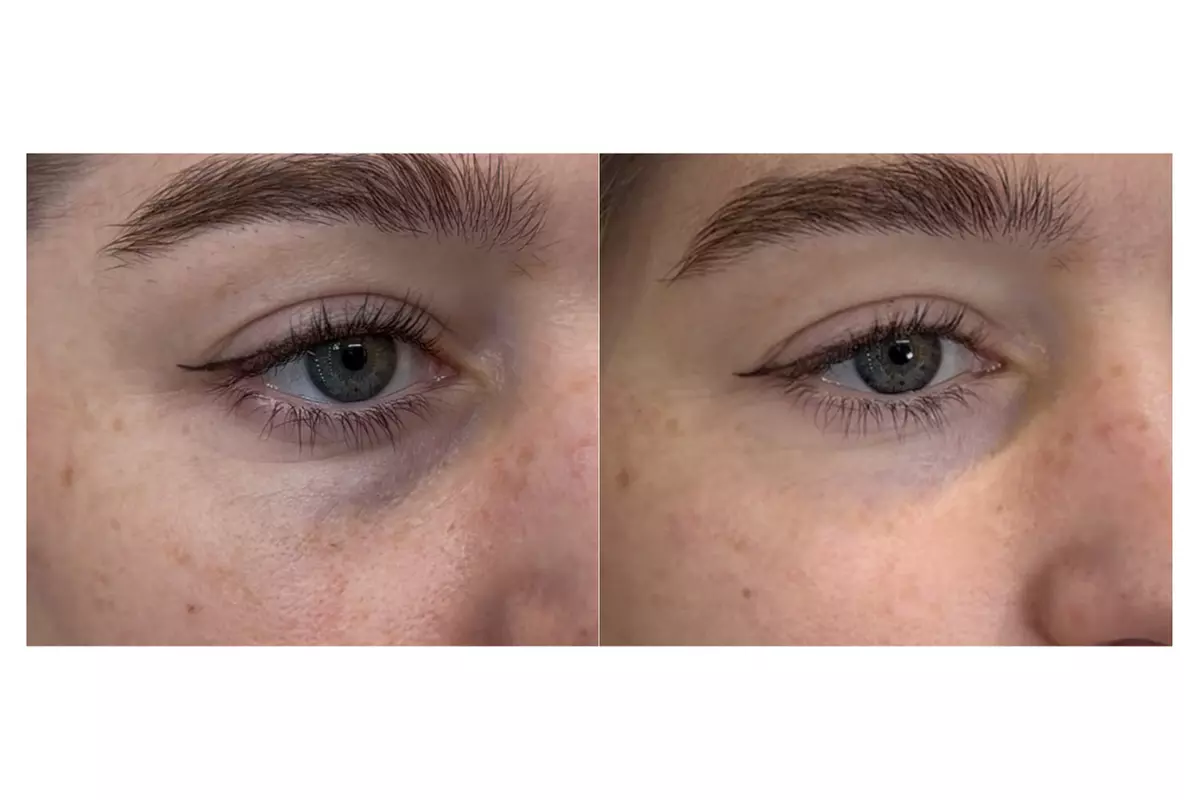 Up to 50% Off on Non Surgical Plasma Fibroblast SkinTightening