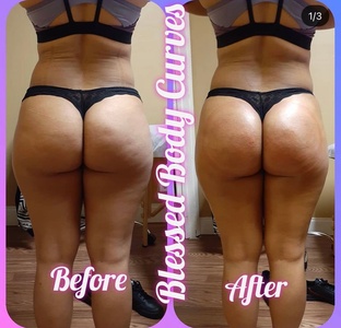Three Sessions of Non-Surgical Brazilian Butt Lift and Basic Cellulite Reduction - Blessed Body Curves