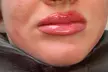 Up to 45% Off on Lip Enhancement at Blaké Aesthetics - Second Medium