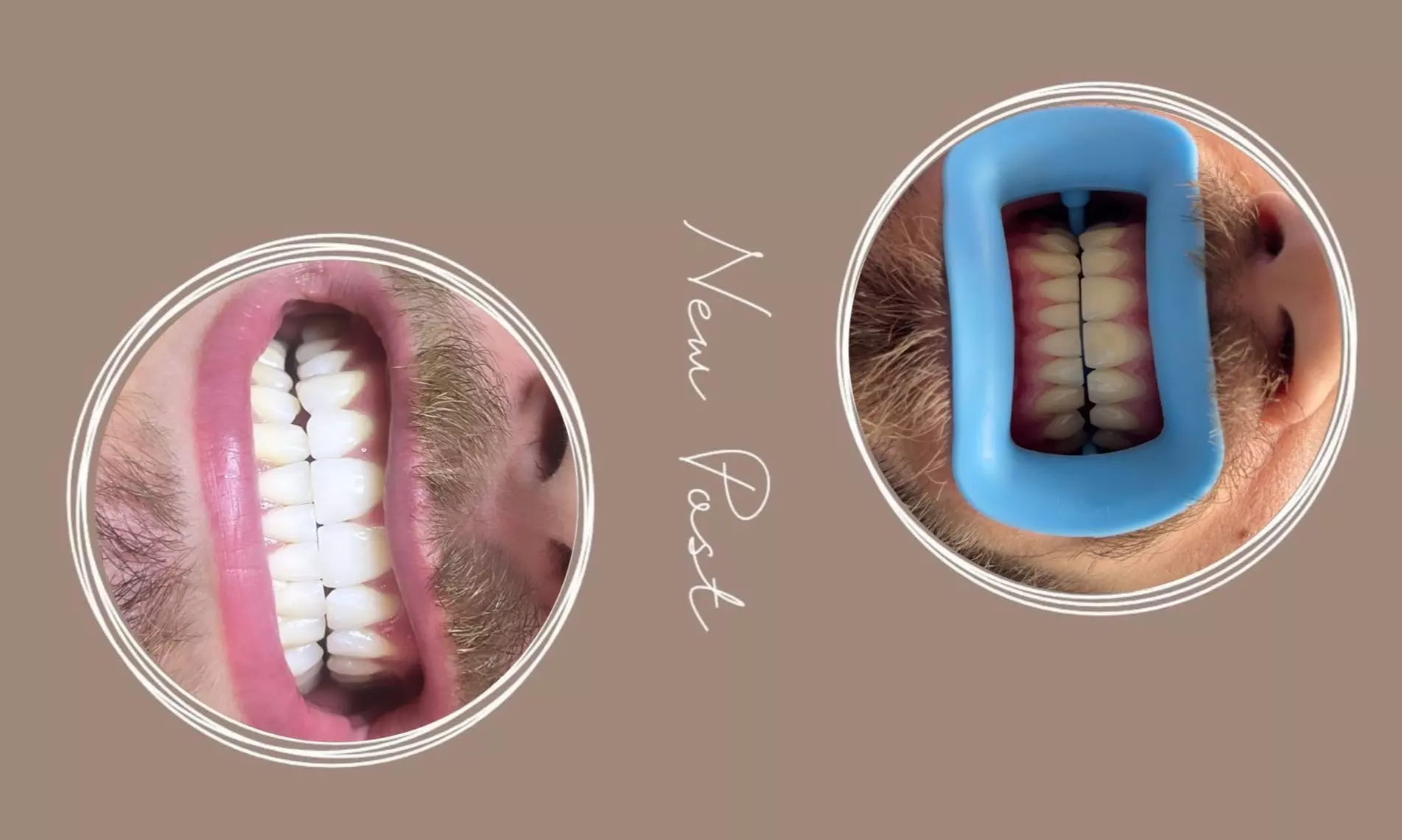 Blanchiment dentaire avec L’atelier de Chloé