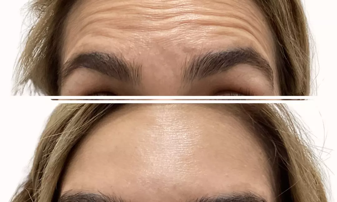 Smooth Your Skin with 20, 40 or 60 Units of Xeomin Injections