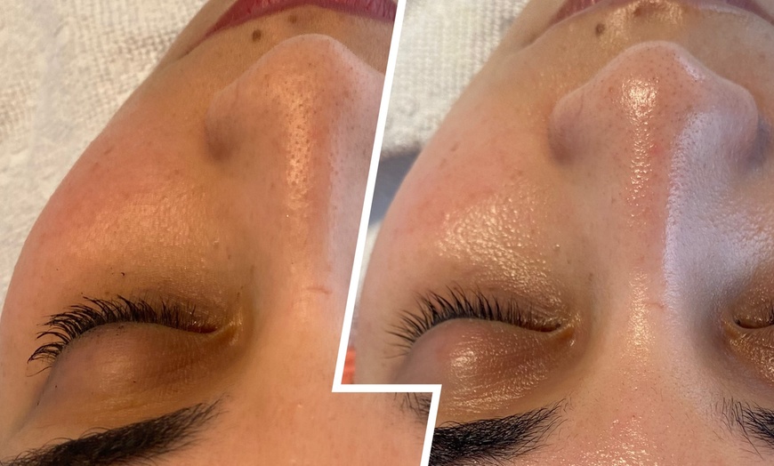 Image 5: Premium Glow-Facial inkl. Wickeltherapie & MatrixxFace für 1 Person