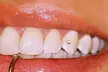 Shine Bright at ALICE BEAUTY SALON RI by Adding One Tooth Gems or a Tooth Gems Butterfly (Up to 36% Off) - Second Medium