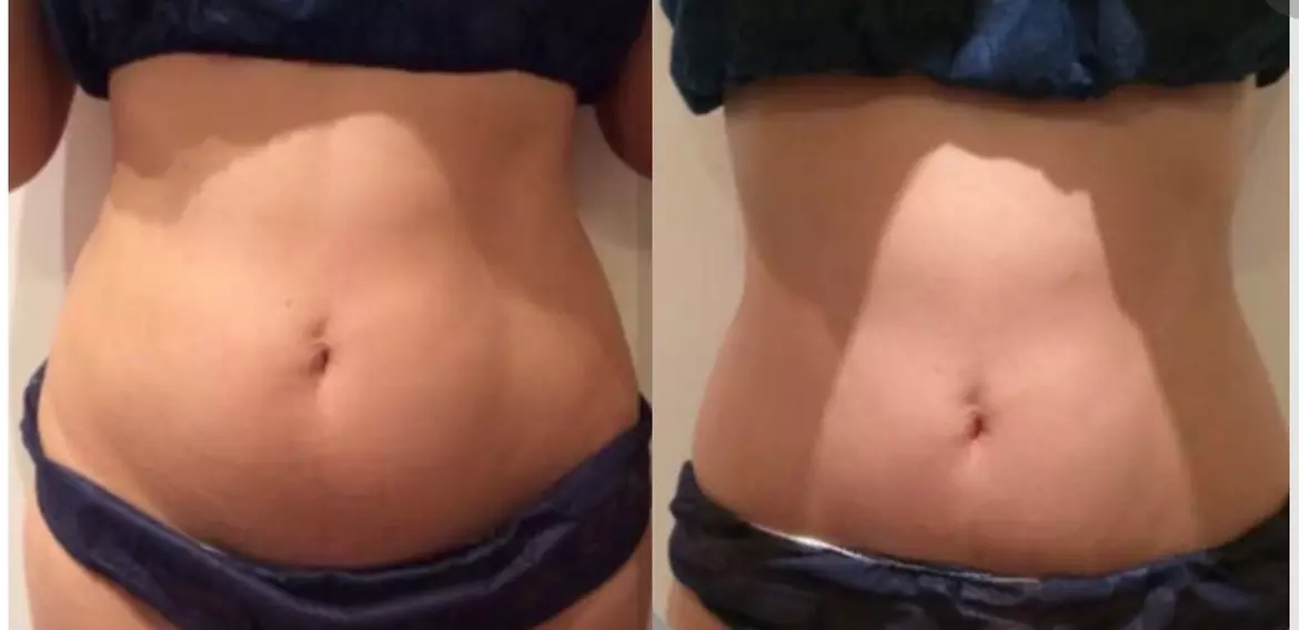 Up to 50% Off on Cavitation at Leveyna