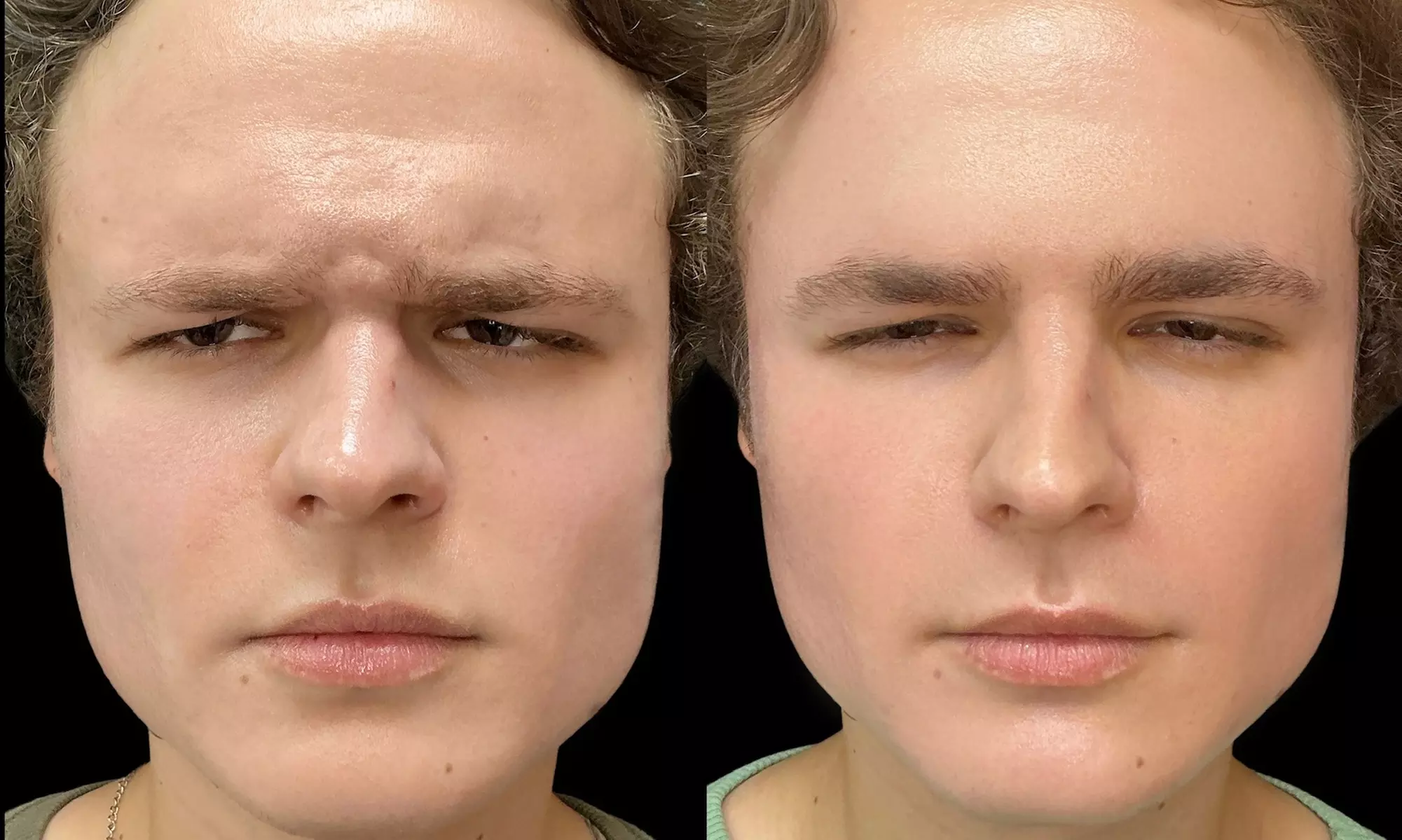 Smooth Away Lines with Botox Lip Flip, 20 or 40 Units of Botox