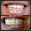 Image 6: Brighten Your Smile With Teeth Whitening, Polishing & More 