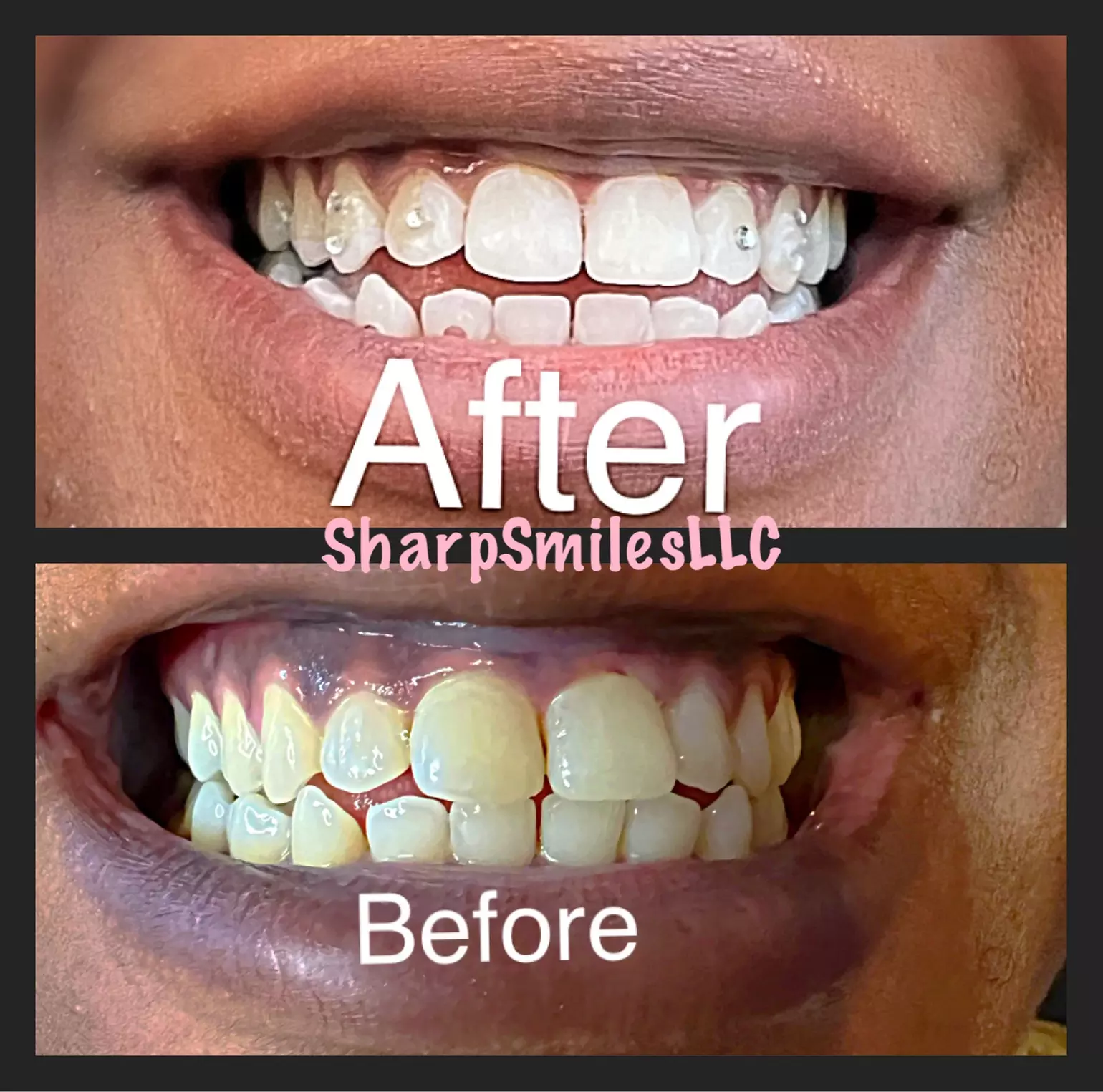Brighten Your Smile With Teeth Whitening, Polishing & More