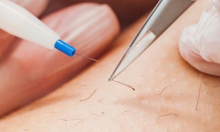 Image 2: 15- or 30-Minute Electrolysis Sessions for Hair Reduction