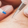 Image 2: 15- or 30-Minute Electrolysis Sessions for Hair Reduction