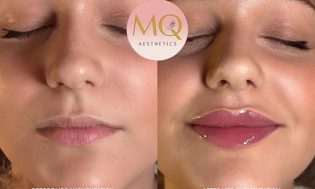 Up to 45% Off on Injection-Other-Dysport, Xeomin at MQ Aesthetics