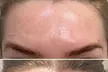Up to 38% Off on Botox Injections Branded at Biorejuvenate - Second Medium