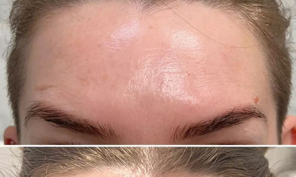 Up to 38% Off on Botox Injections Branded at Biorejuvenate