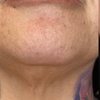 Image 1: One IPL/Photofacial Treatment For Face, with Optional Neck or Chest 