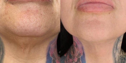 One IPL Photofacial Treatment for Hands (Arms not Included) - Seemas Botox and Aesthetics
