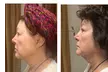 Up to 58% Off on Facelift - Non-Surgical at Your Sculpt Studio - Second Medium