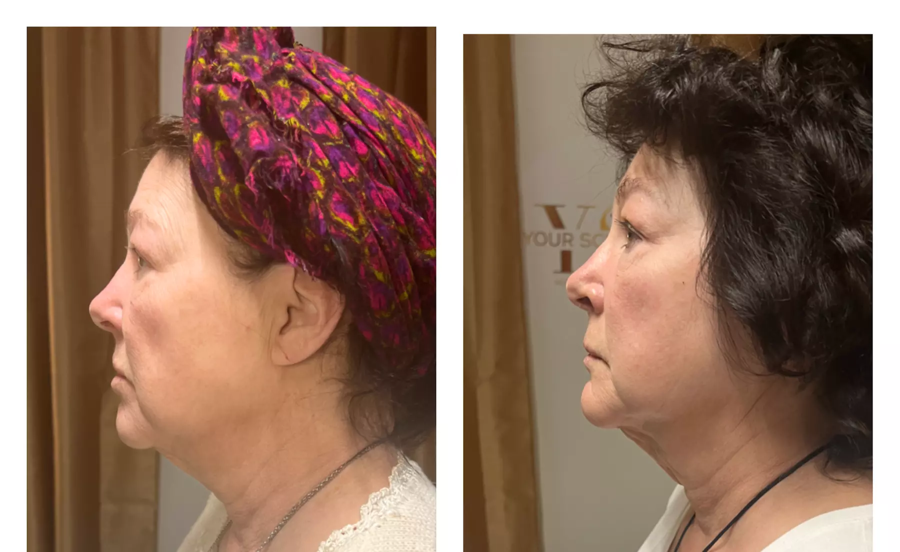 Up to 62% Off on Facelift - Non-Surgical at Your Sculpt Studio