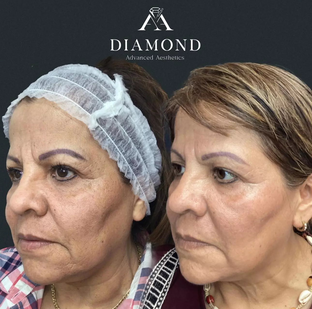 One Fraxel Laser Skin Resurfacing Treatment for Neck or Full Face