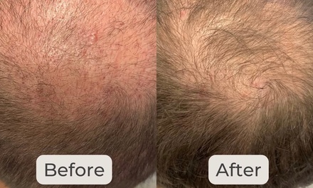 One PRP Platelet-Rich Plasma Hair-Restoration Treatment - Skinovatio Medical Spa