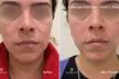 Up to 64% Off on Ultherapy / Ultrasonic Facial at One Beauty Aesthetics - Second Medium