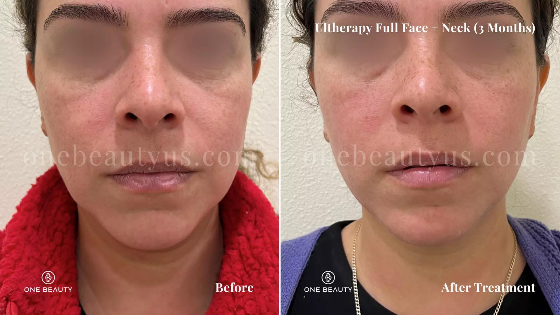 Ultherapy / Ultrasonic Facial at One Beauty Aesthetics
