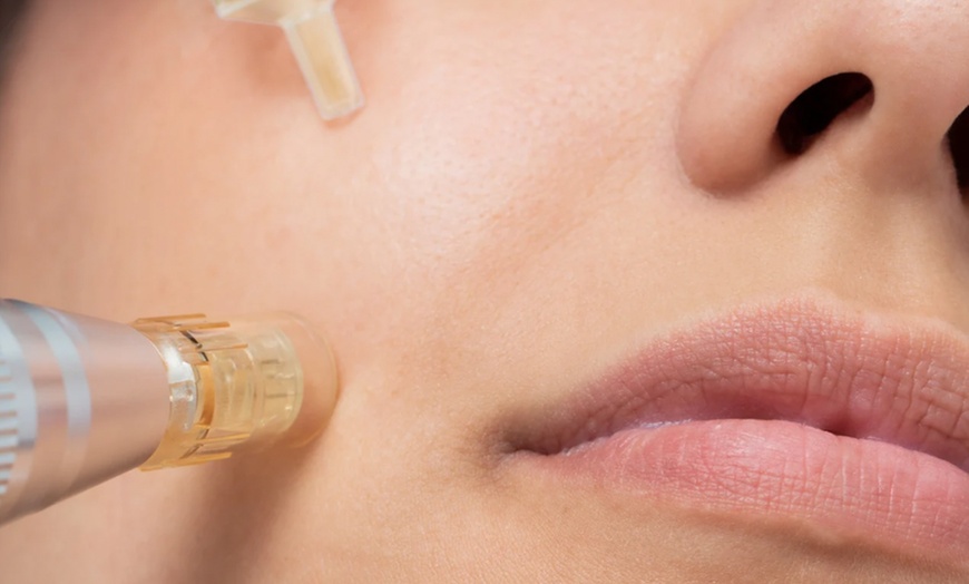 Image 3: One or Three Sessions of Skin or EMS Micro-Needling For Face or Neck