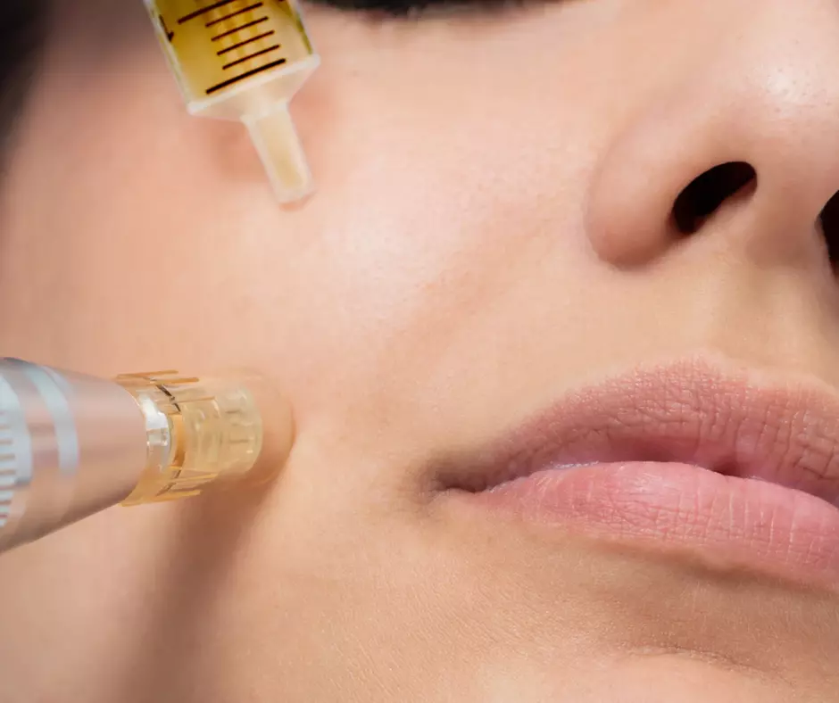 One or Three Sessions of Skin or EMS Micro-Needling For Face or Neck